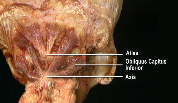 Fig. 1 – Transitional muscular forces from above and below attached to C2 – Courtesy Robert Acland