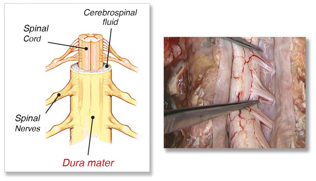 Fig. 4 - Dura Mater