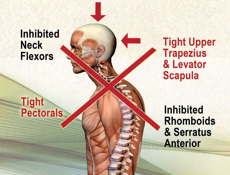 Figure 1. Upper Cross Syndrome