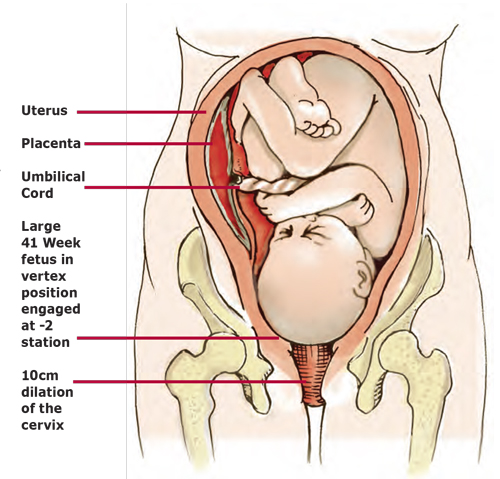 Figure 8: Intrauterine constraint caused by pelvic misalignment can alter the baby’s position and adversely affect the developing spine and cranium. Adapted from Bill Allen with permission.