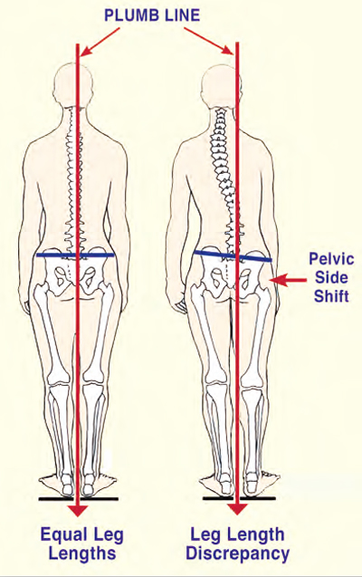 Figure 6: Vestibular dominance produces left-legged weight bearing that not only flattens lumbar lordosis and posteriorly rotates the left ilium, but also causes the right ilium to drop in an anterior/inferior direction.