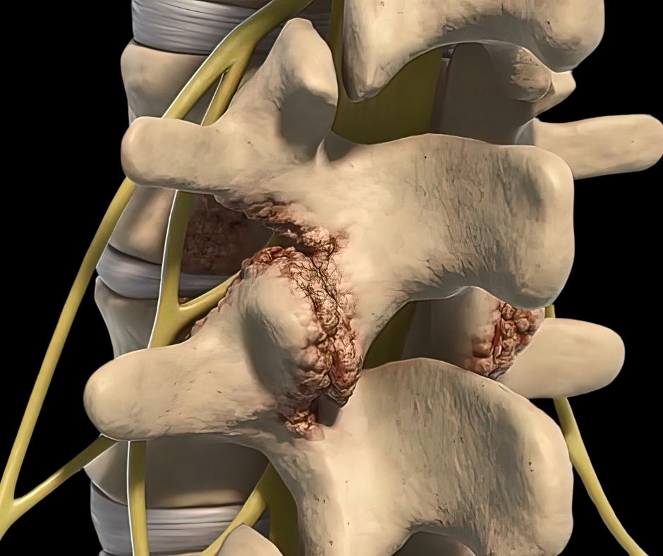 Illustration of Z joint osteoarthritis showing osteophyte formation and degenerative changes in the lumbar facet joints